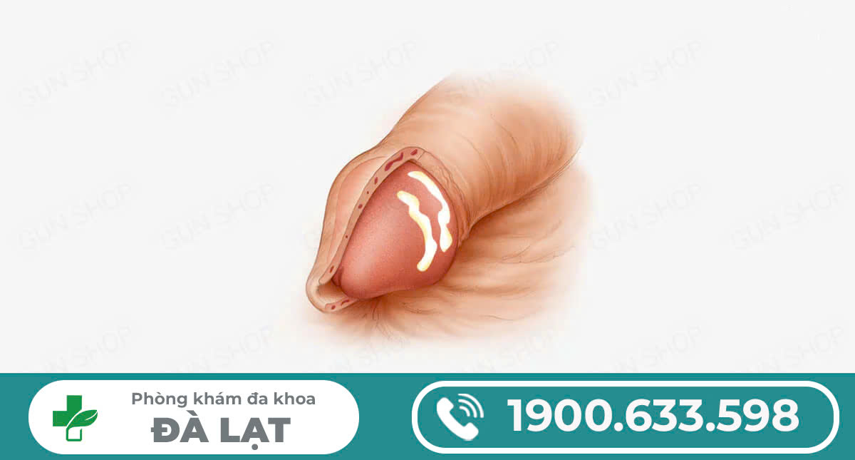 Hình ảnh minh họa